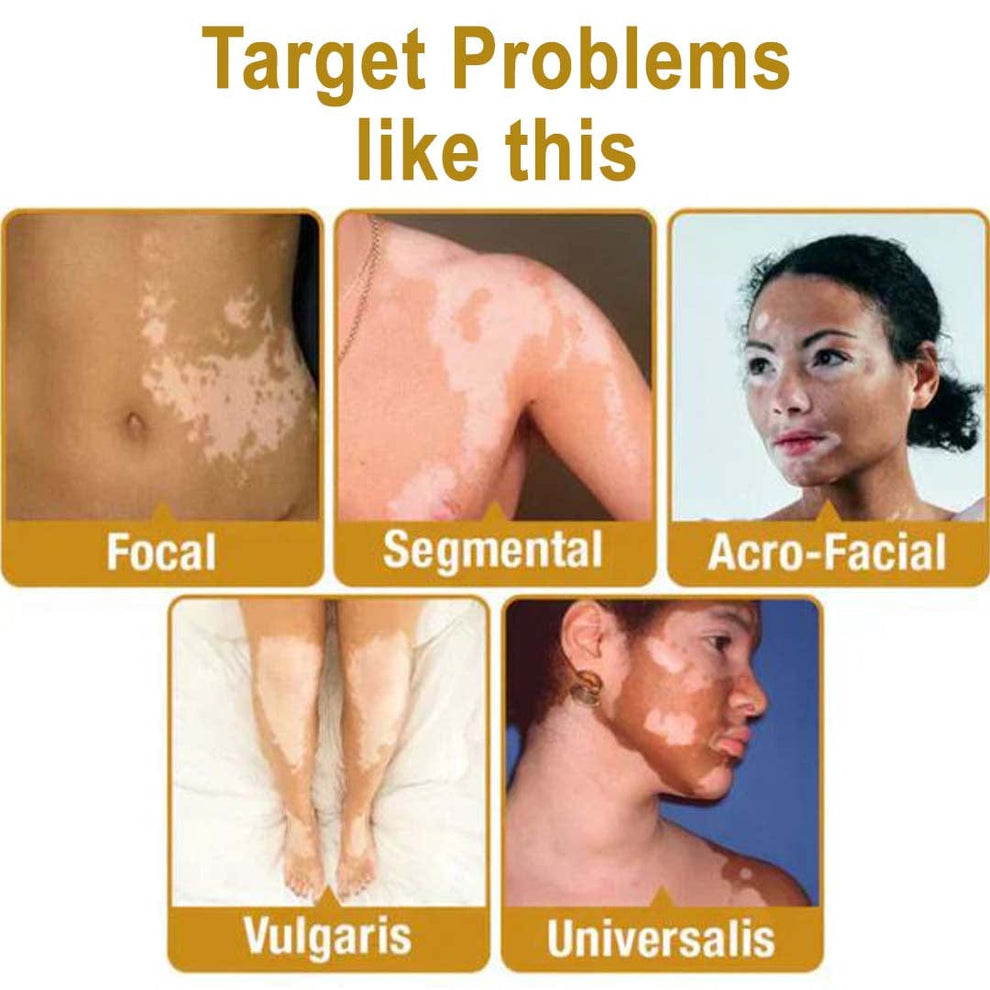 MD Vitigo™ Advanced Vitiligo Restore Cream ✨ | Buy 1 Get 1 Free