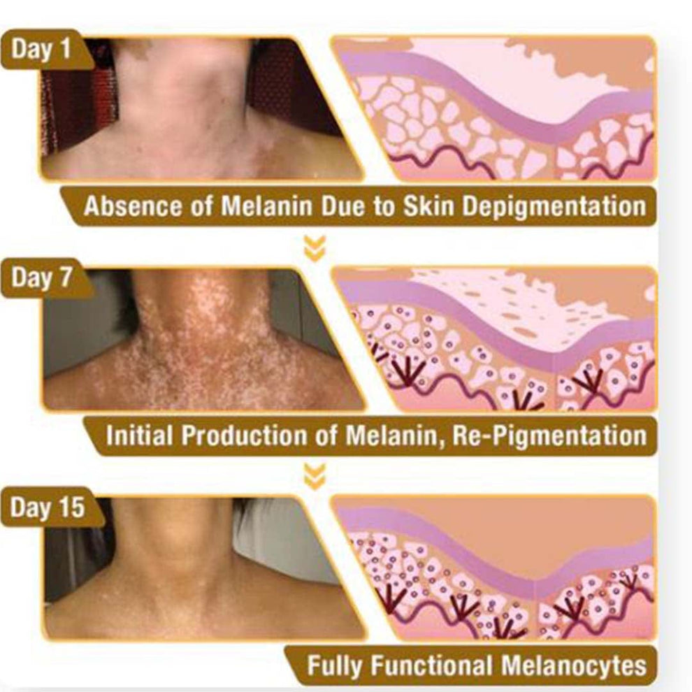 MD Vitigo™ Advanced Vitiligo Restore Cream ✨ | Buy 1 Get 1 Free