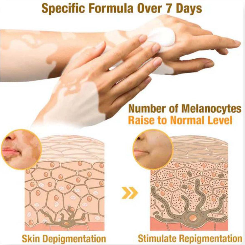 MD Vitigo™ Advanced Vitiligo Restore Cream ✨ | Buy 1 Get 1 Free