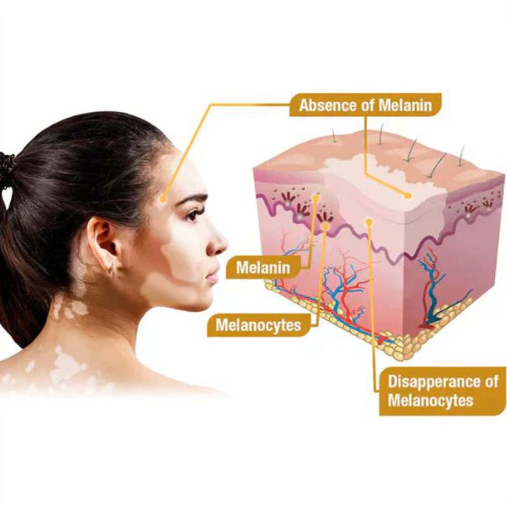 MD Vitigo™ Advanced Vitiligo Restore Cream ✨ | Buy 1 Get 1 Free